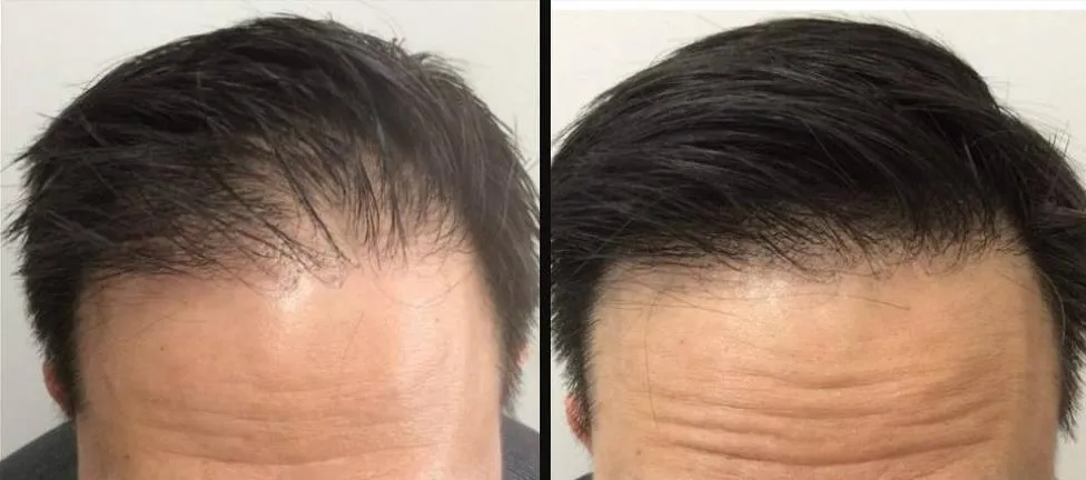 Före och efter PRP-behandling